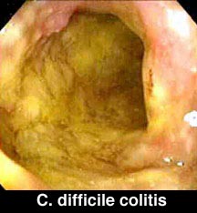 imgCdifficile