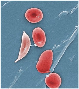1911_Sickle_Cells