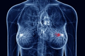 1376424959_breast_cancer